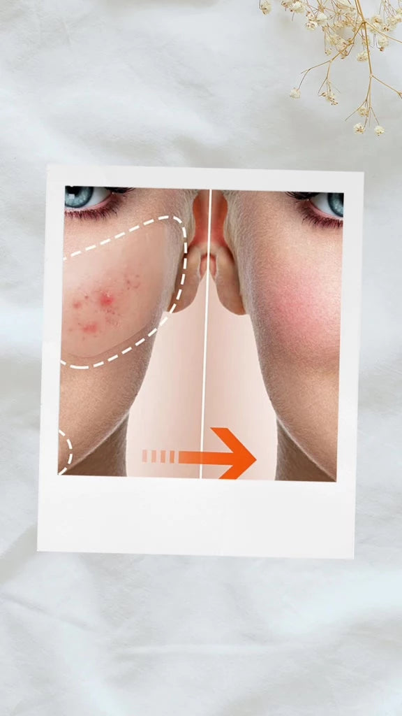 Creme Facial Anti-Acne com Ácido Salicílico para Remover Óleo e Cabeça Preta, Clareador de Cicatrizes