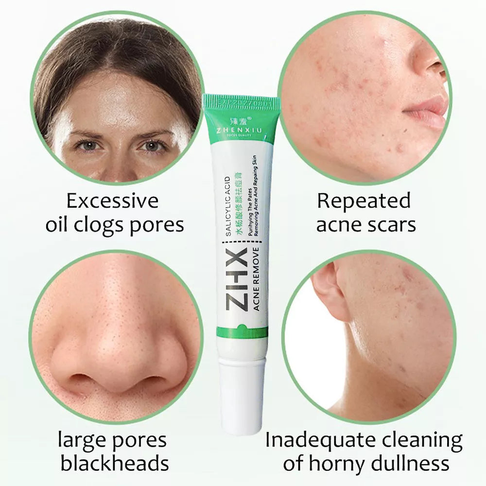 Creme Facial Anti-Acne com Ácido Salicílico para Remover Óleo e Cabeça Preta, Clareador de Cicatrizes