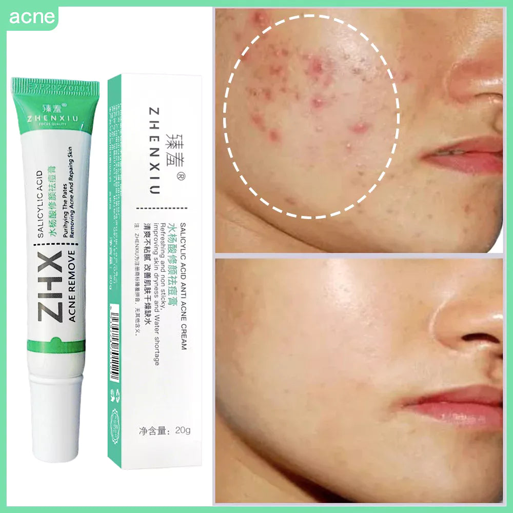 Creme Facial Anti-Acne com Ácido Salicílico para Remover Óleo e Cabeça Preta, Clareador de Cicatrizes
